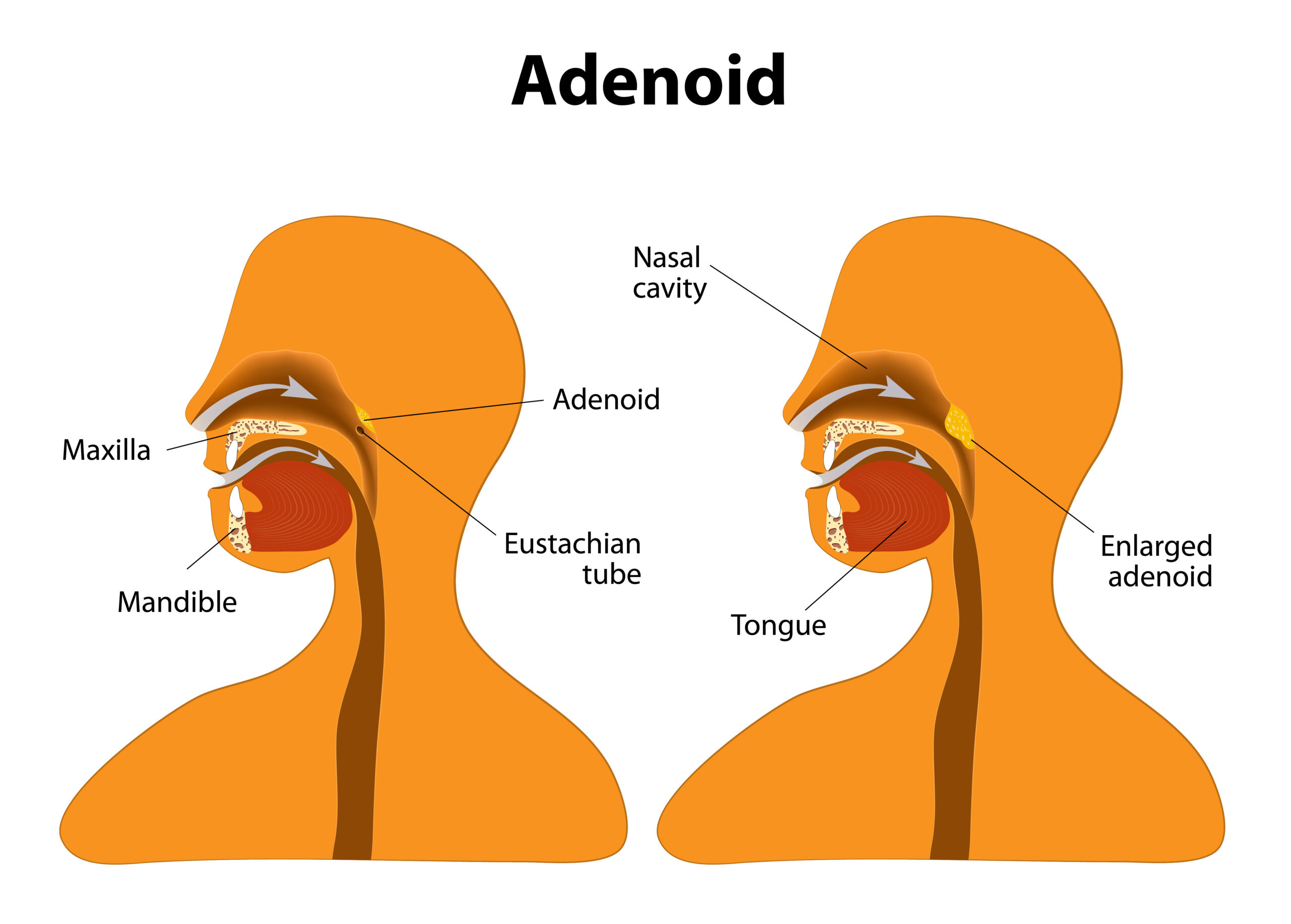 Swollen Adenoids In Nose